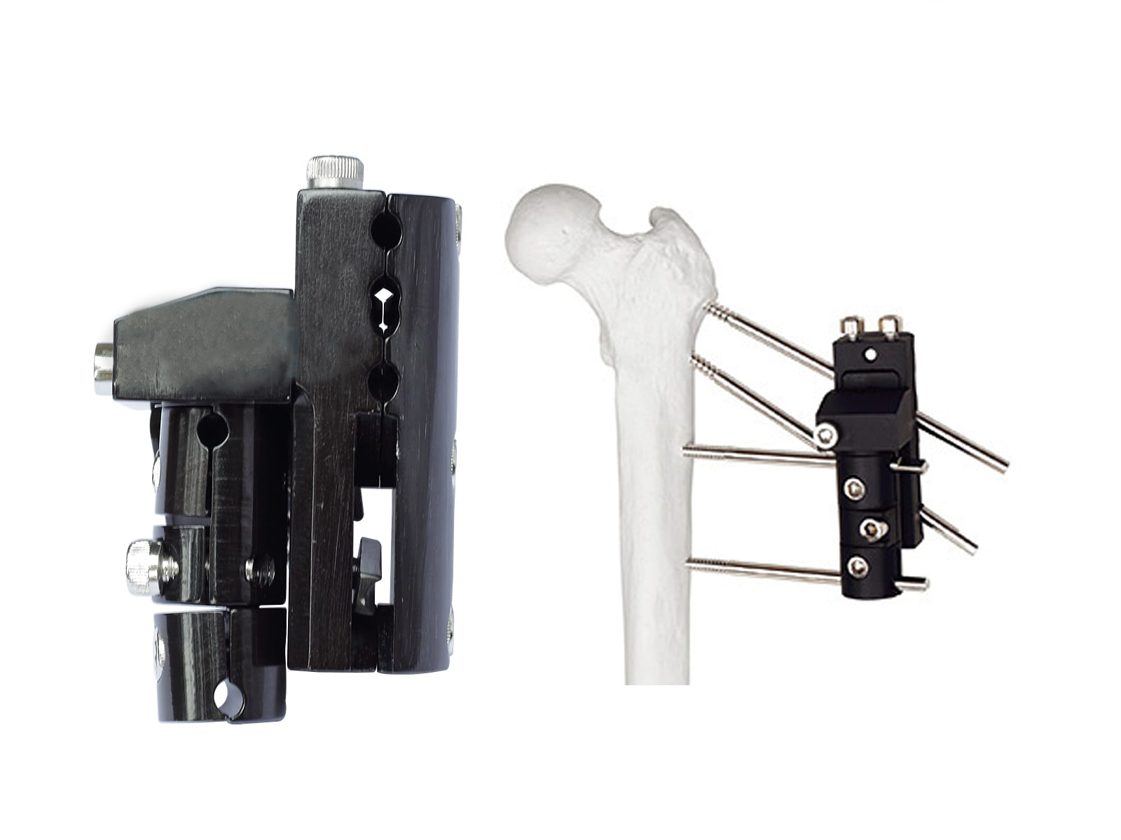 Pertrochanteric External Fixator